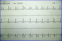 EKG tracing